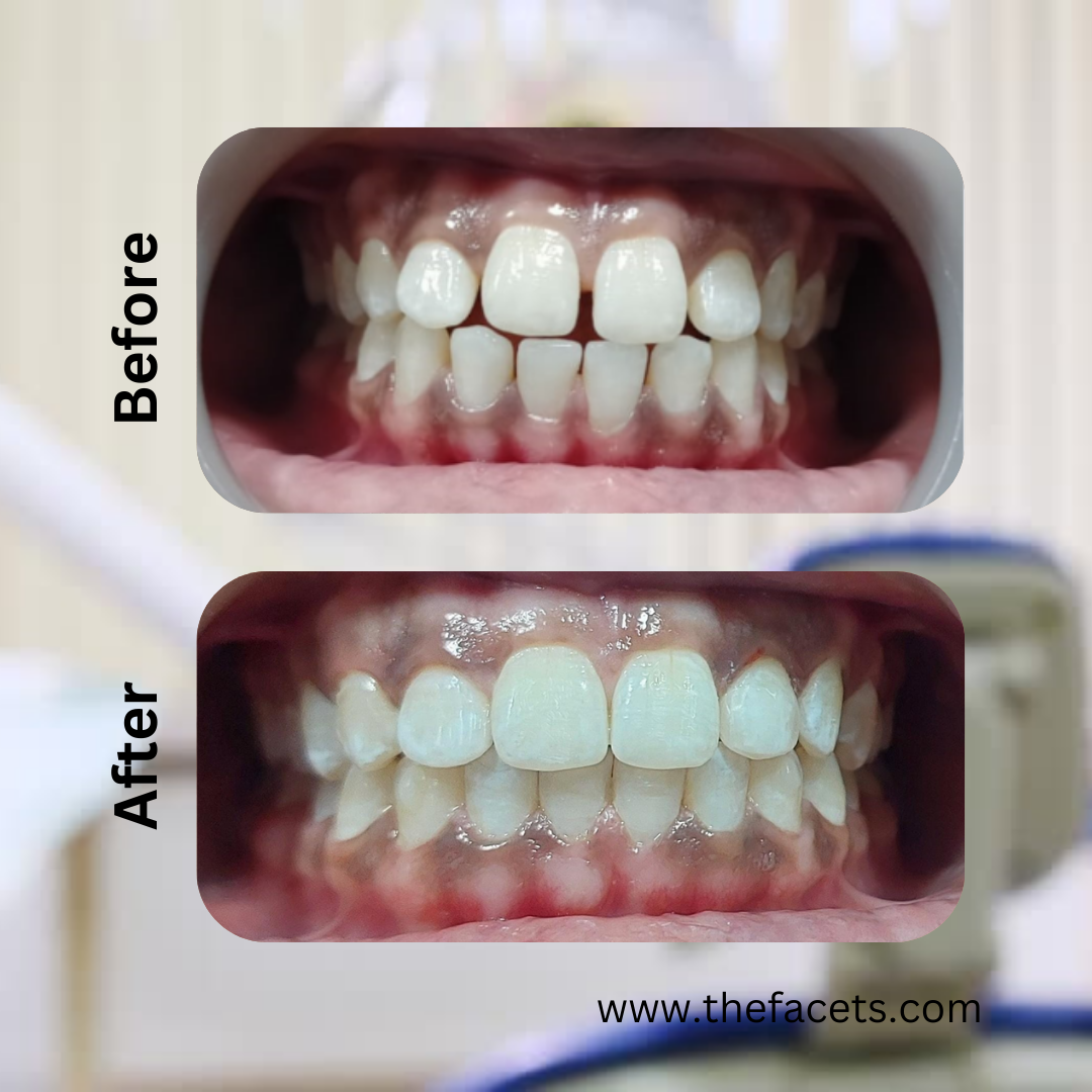 Before and after clear aligner treatment result 10